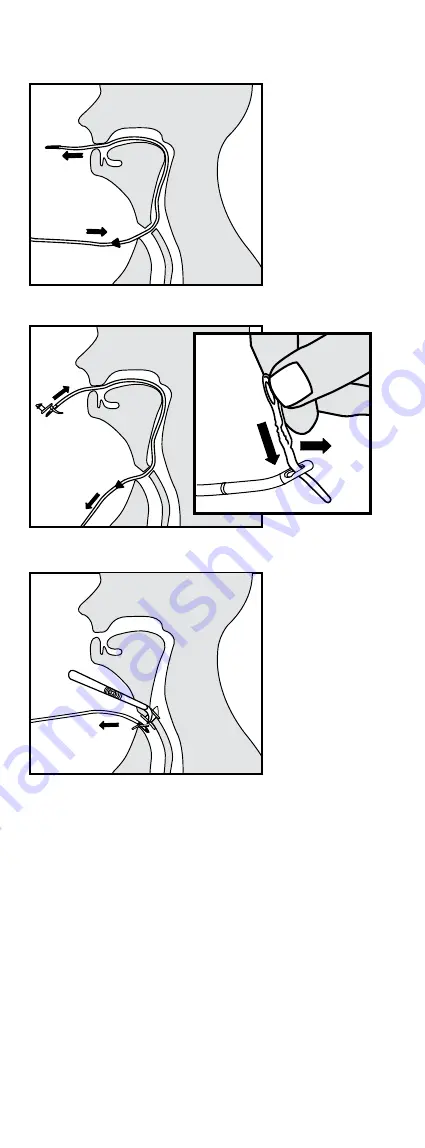 Atos Medical Provox GuideWire Instructions For Use Manual Download Page 6