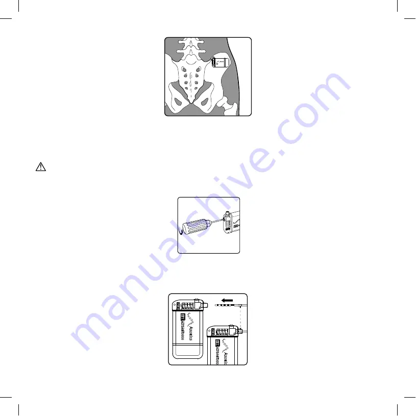 Axonics 1101 Скачать руководство пользователя страница 13