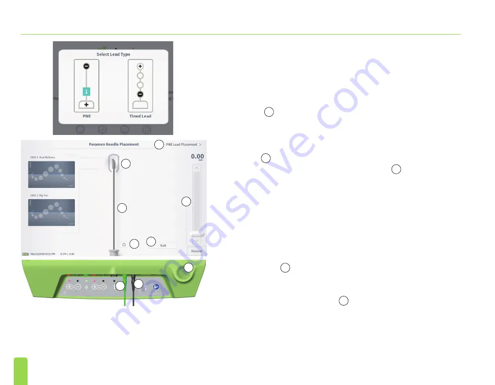 Axonics SNM System 2501 Скачать руководство пользователя страница 94