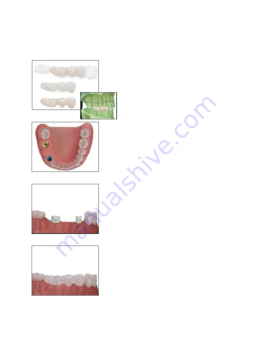 Biomet 3i Navigator Procedures Manual Download Page 22