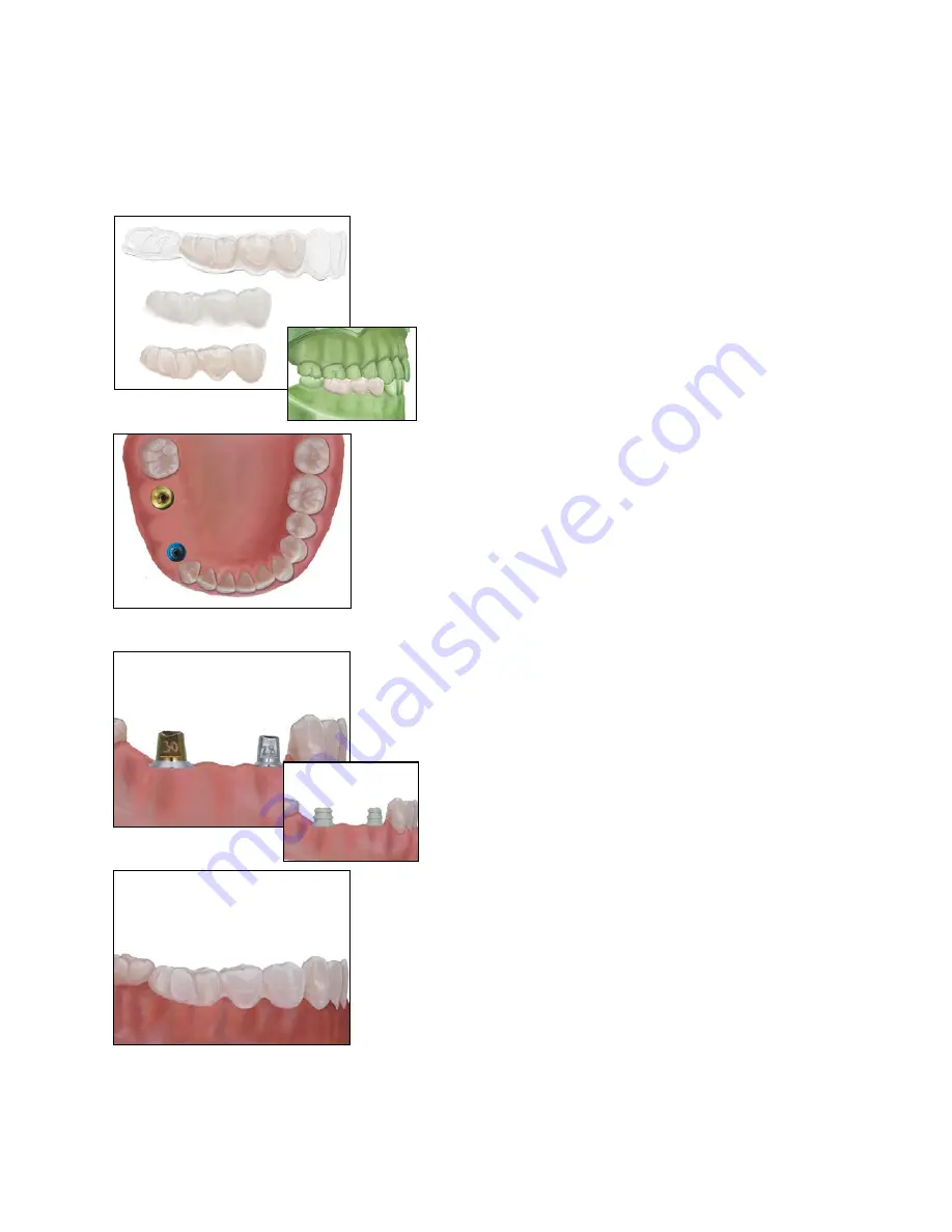 Biomet 3i Navigator Procedures Manual Download Page 24