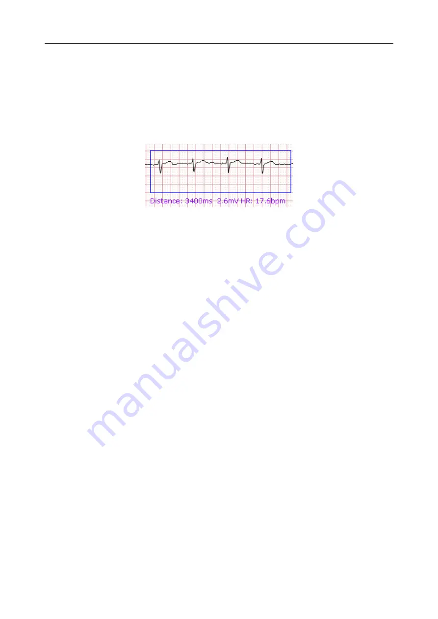 EDAN INSTRUMENTS VE-1010 User Manual Download Page 33