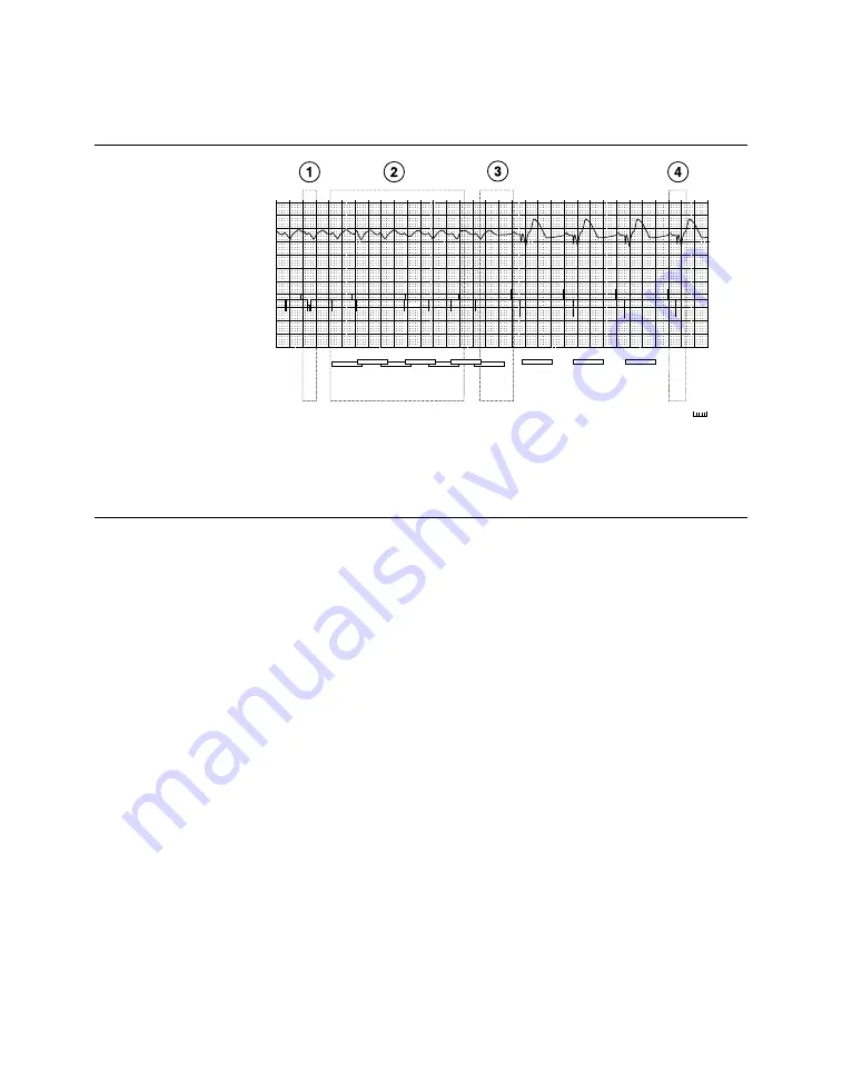 Medtronic PROTECTA XT DR D314DRG Clinician Manual Download Page 383