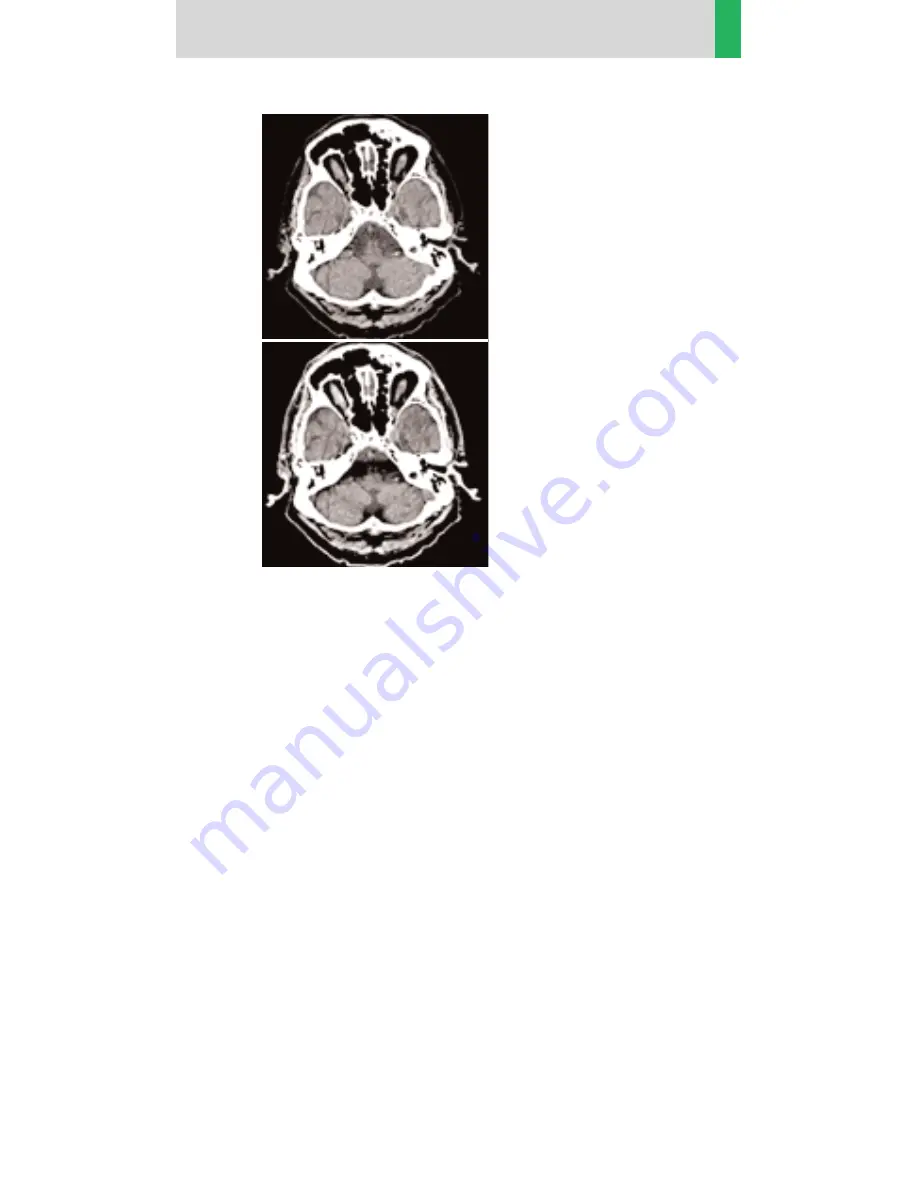 Siemens SOMATOM Emotion 6 Application Manual Download Page 13