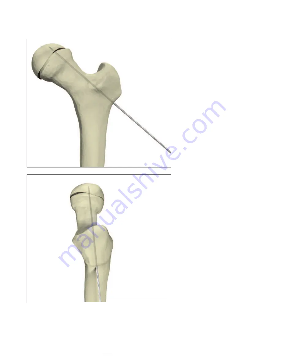 Stryker Hansson Pin System Manual Download Page 8