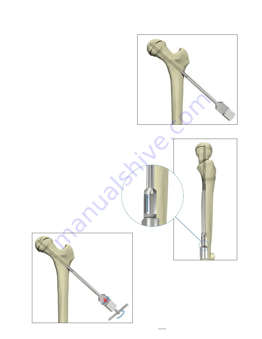 Stryker Hansson Pin System Manual Download Page 13