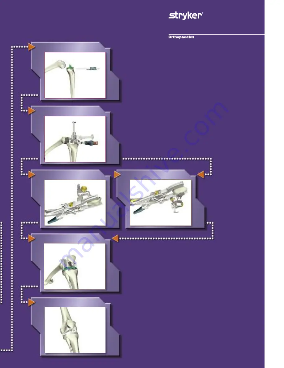 Stryker Triathlon Knee System Скачать руководство пользователя страница 6