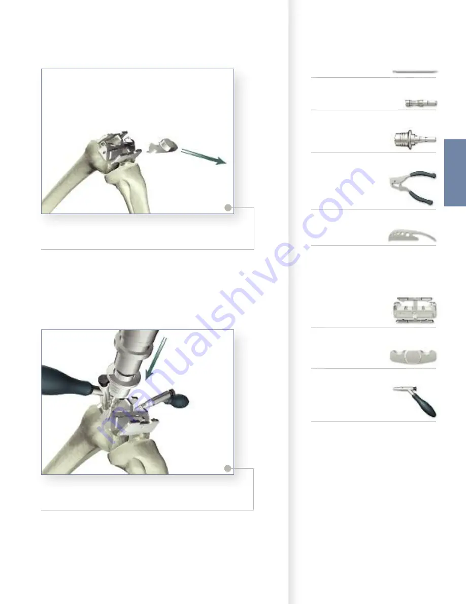 Stryker Triathlon Knee System Surgical Protocol Download Page 29