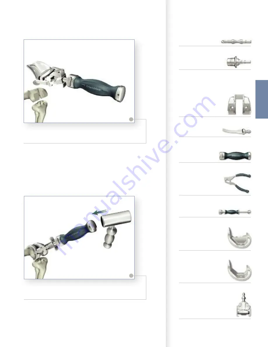 Stryker Triathlon Knee System Surgical Protocol Download Page 35