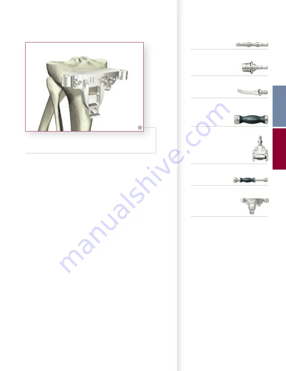 Stryker Triathlon Knee System Surgical Protocol Download Page 37