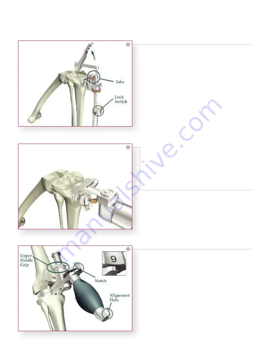 Stryker Triathlon Knee System Surgical Protocol Download Page 42