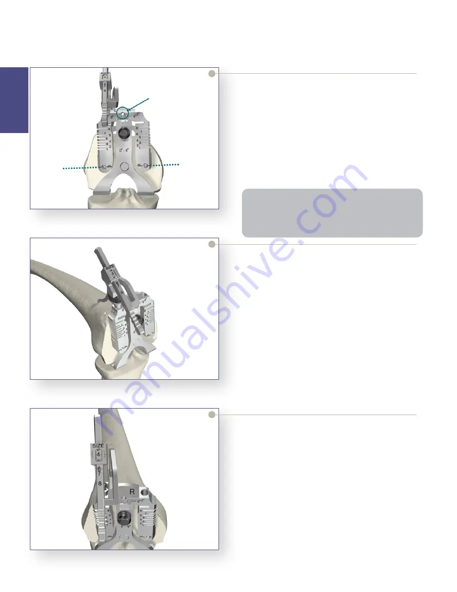 Stryker Triathlon Tritanium Surgical Manualline Download Page 12