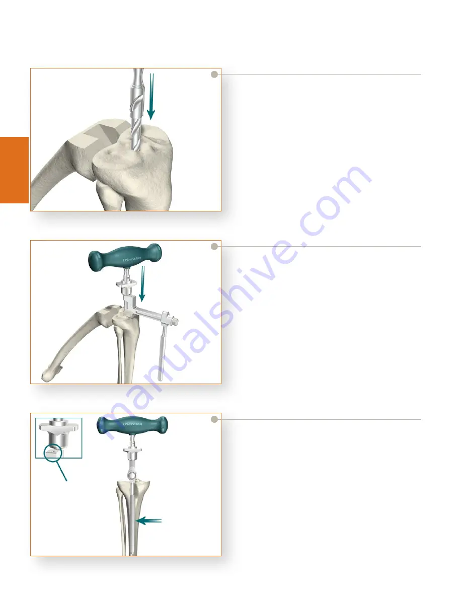 Stryker Triathlon Tritanium Surgical Manualline Download Page 26