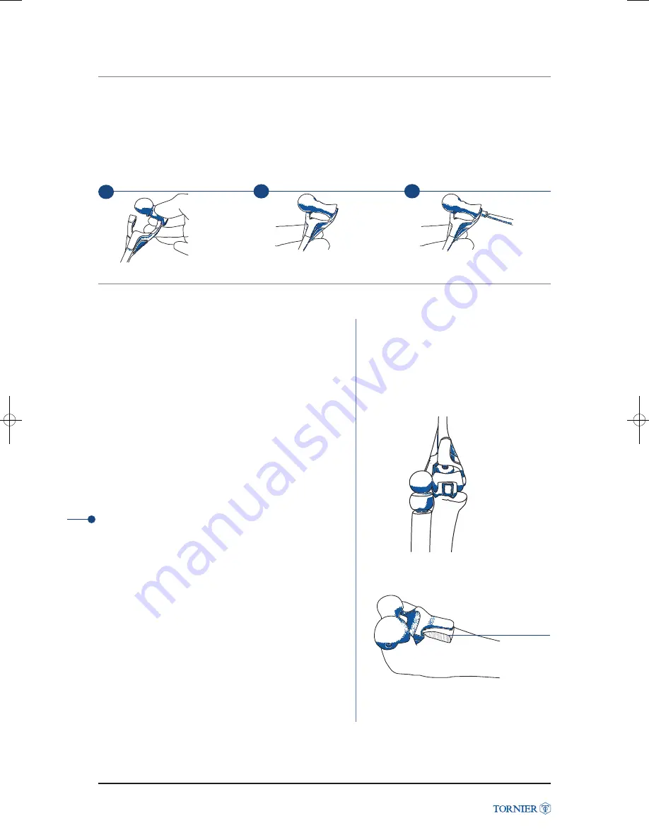 Tornier Latitude Manual Download Page 34