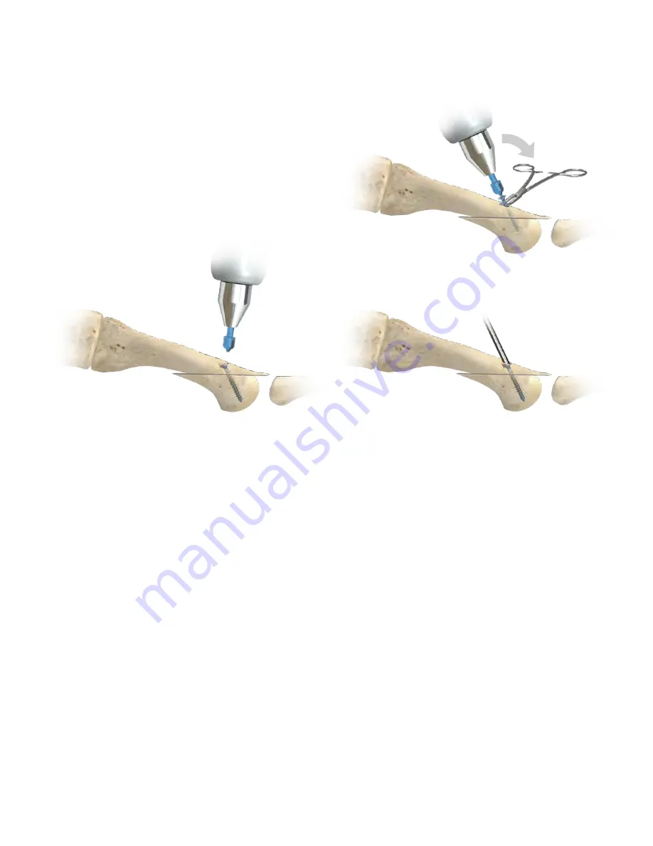 Zimmer Biomet Headless Compression
and Twist-Off Screws Surgical Technique Download Page 15