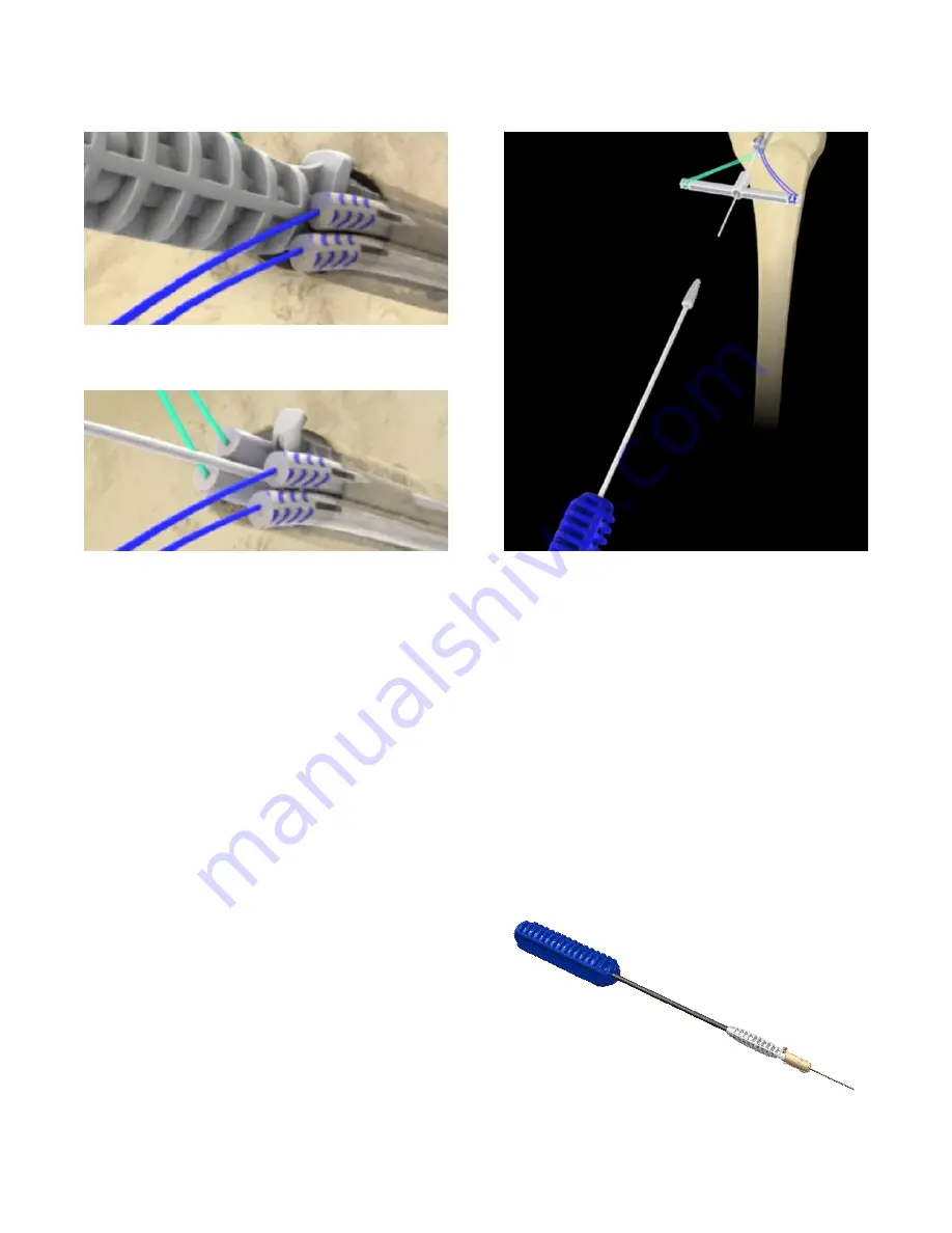 Zimmer Biomet The AperFix Surgical Technique Download Page 10