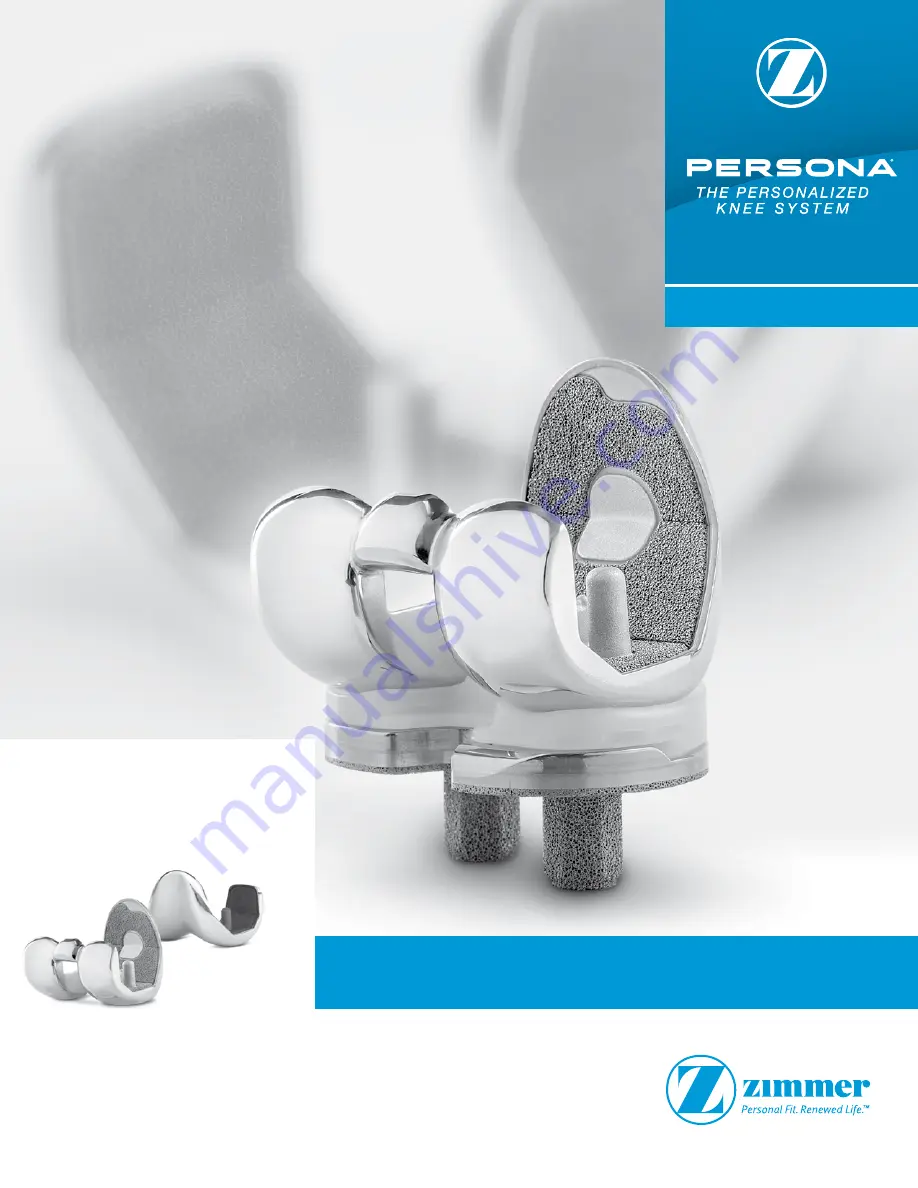 Zimmer Persona Trabecular Metal Femoral Component Скачать руководство пользователя страница 1