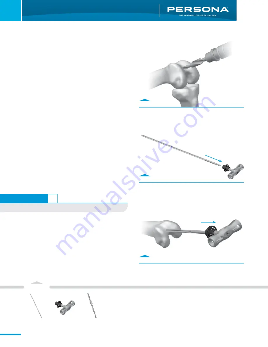 Zimmer Persona Trabecular Metal Femoral Component Surgical Technique Download Page 6