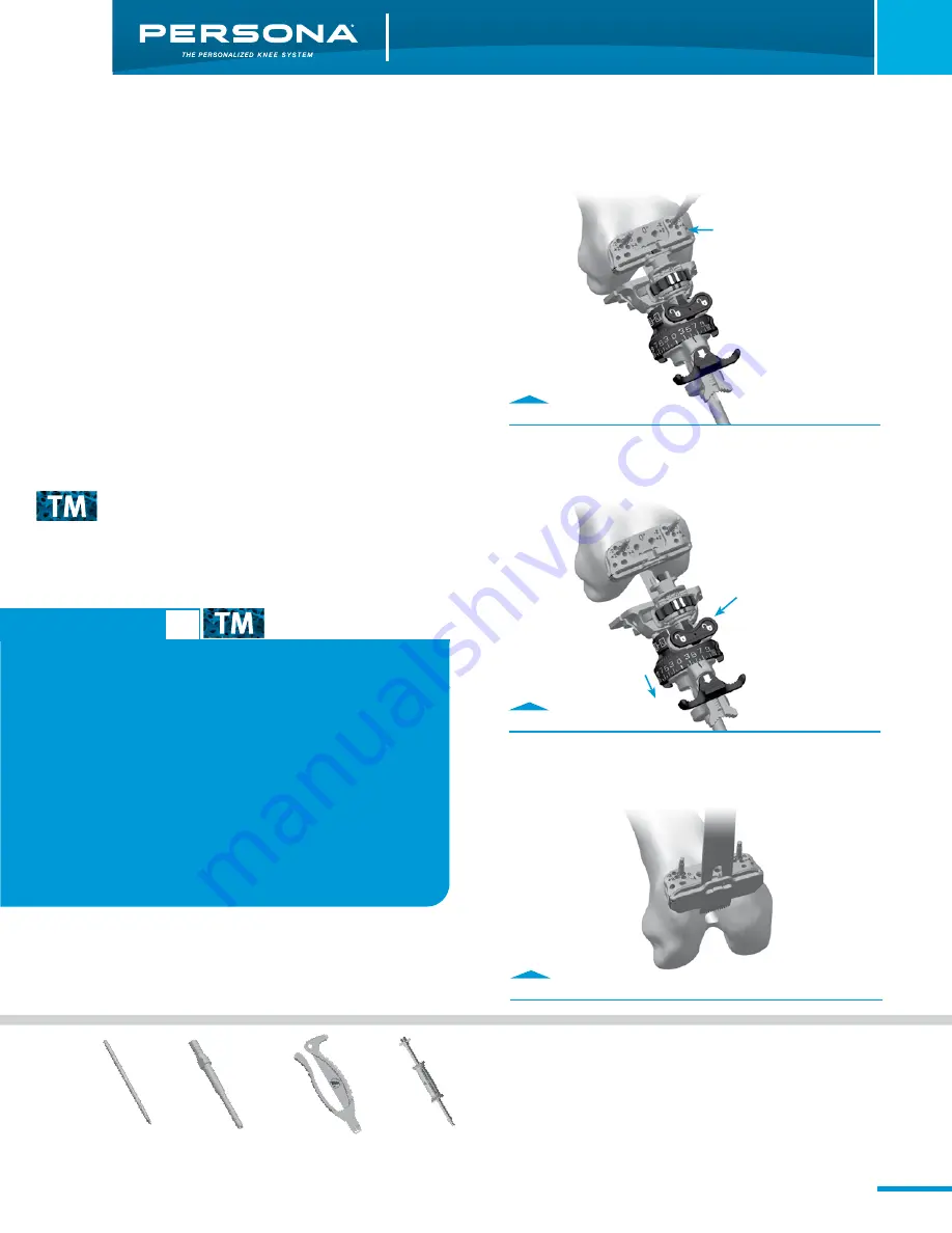 Zimmer Persona Trabecular Metal Femoral Component Surgical Technique Download Page 9