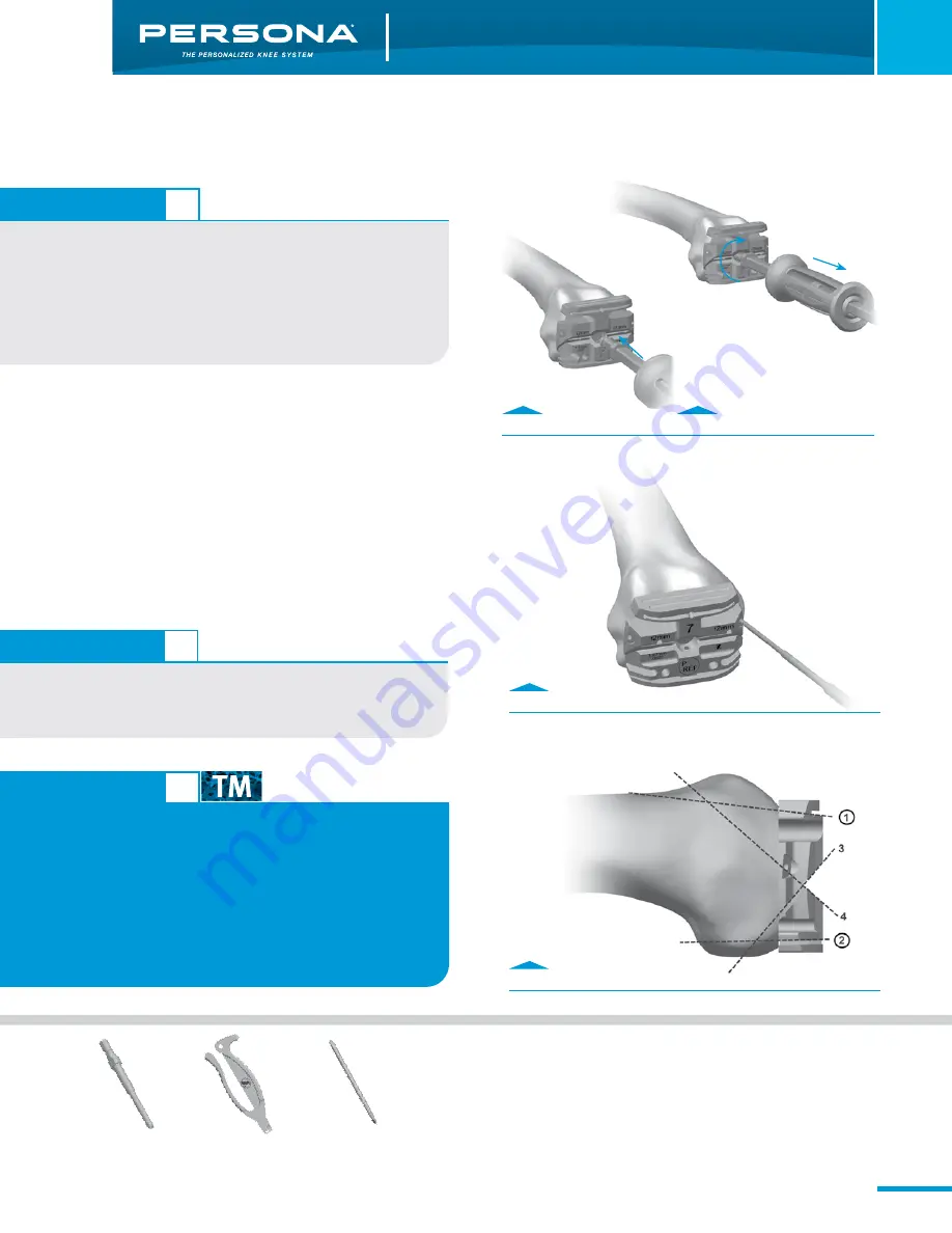 Zimmer Persona Trabecular Metal Femoral Component Скачать руководство пользователя страница 13