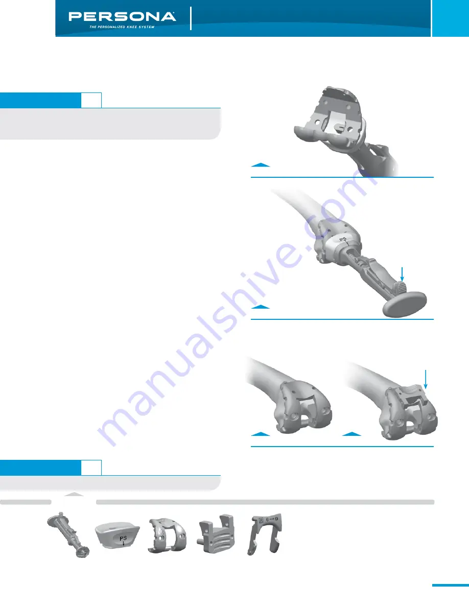 Zimmer Persona Trabecular Metal Femoral Component Скачать руководство пользователя страница 17