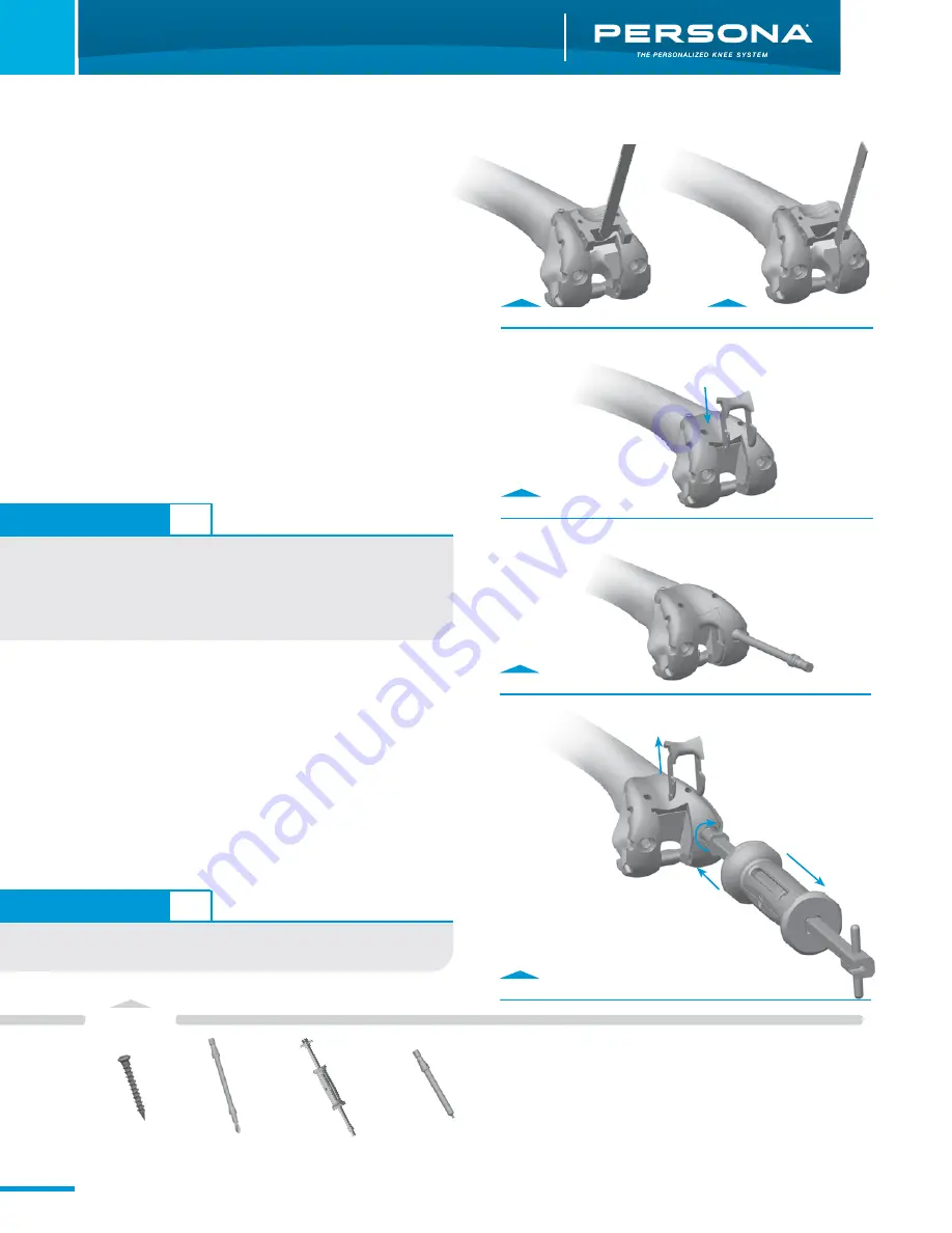 Zimmer Persona Trabecular Metal Femoral Component Surgical Technique Download Page 18