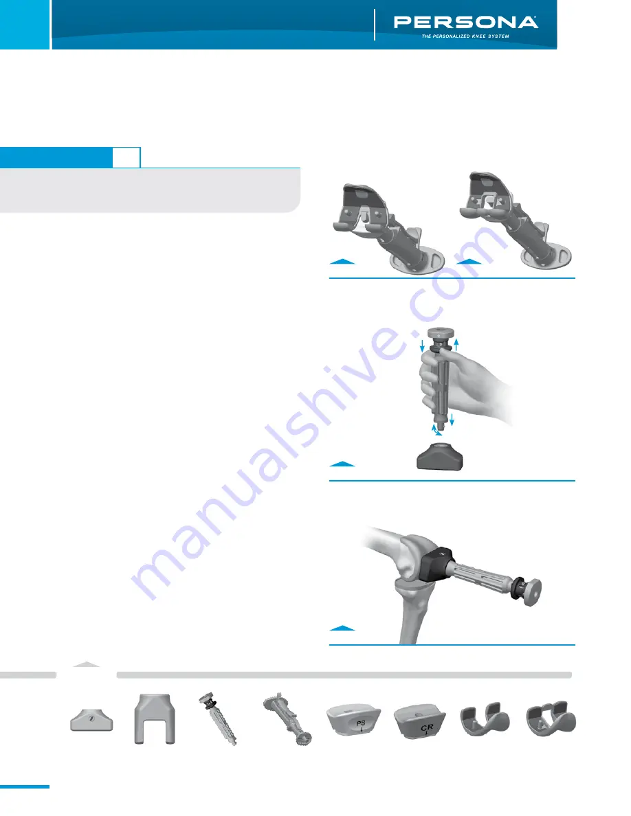 Zimmer Persona Trabecular Metal Femoral Component Surgical Technique Download Page 20