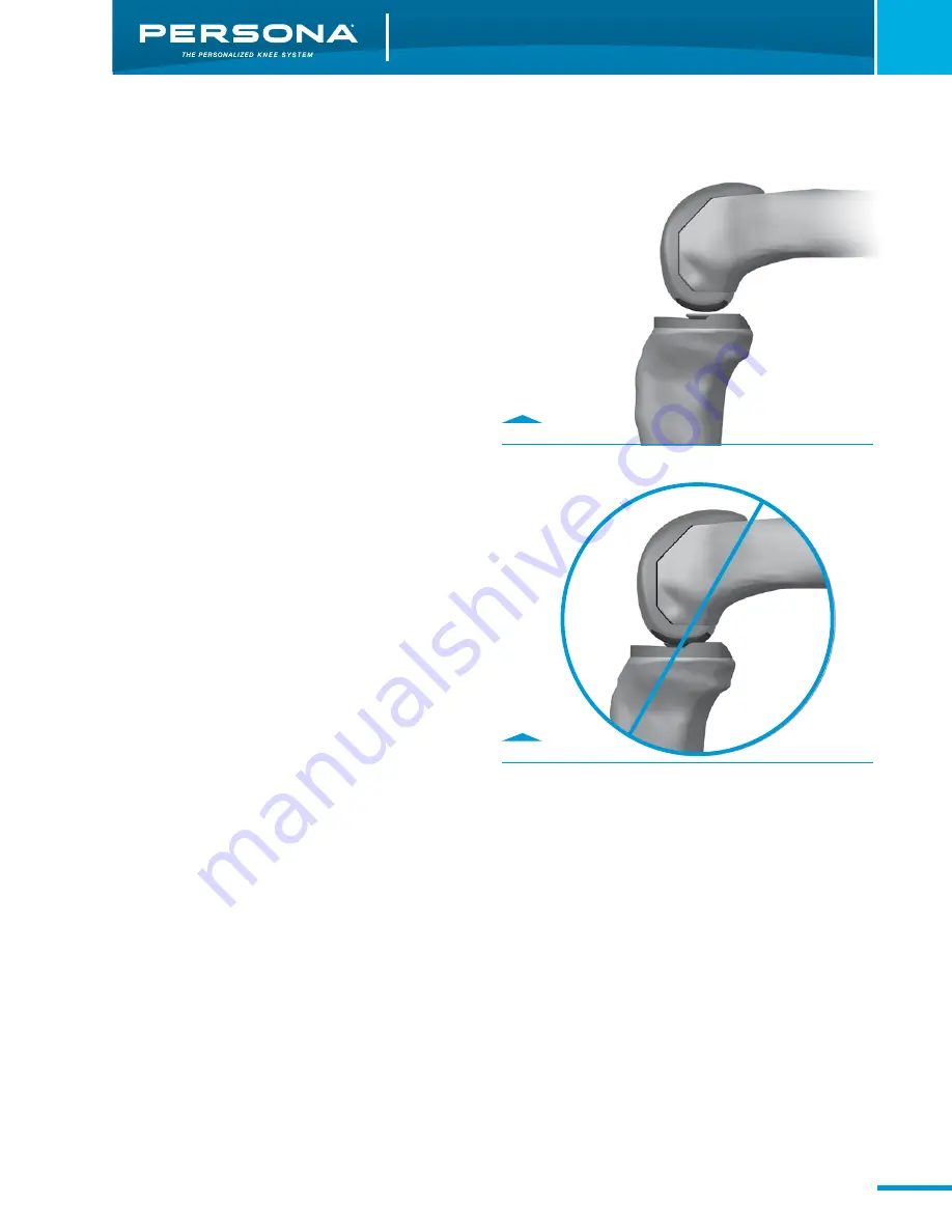 Zimmer Persona Trabecular Metal Femoral Component Скачать руководство пользователя страница 21